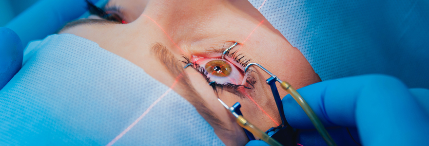 Chirurgie cataracte par laser